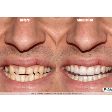 Tooth Before & After Image