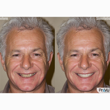 Tooth Before & After Image