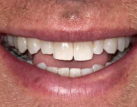 Smile Makeover with Clear Aligner Orthodontics - After