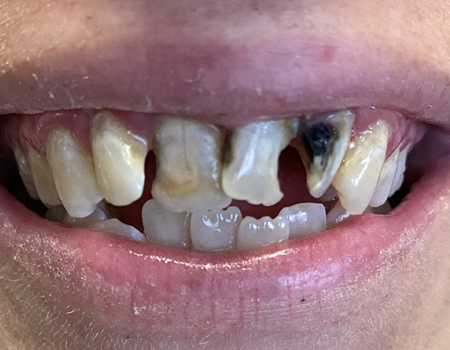 Smile Makeover with Porcelain Crowns - Before