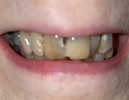 Smile Makeover with Partial Denture/Removable Bridge - Before