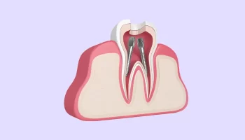 How Long Should One Wait to Get A Tooth Crown After A Root Canal?