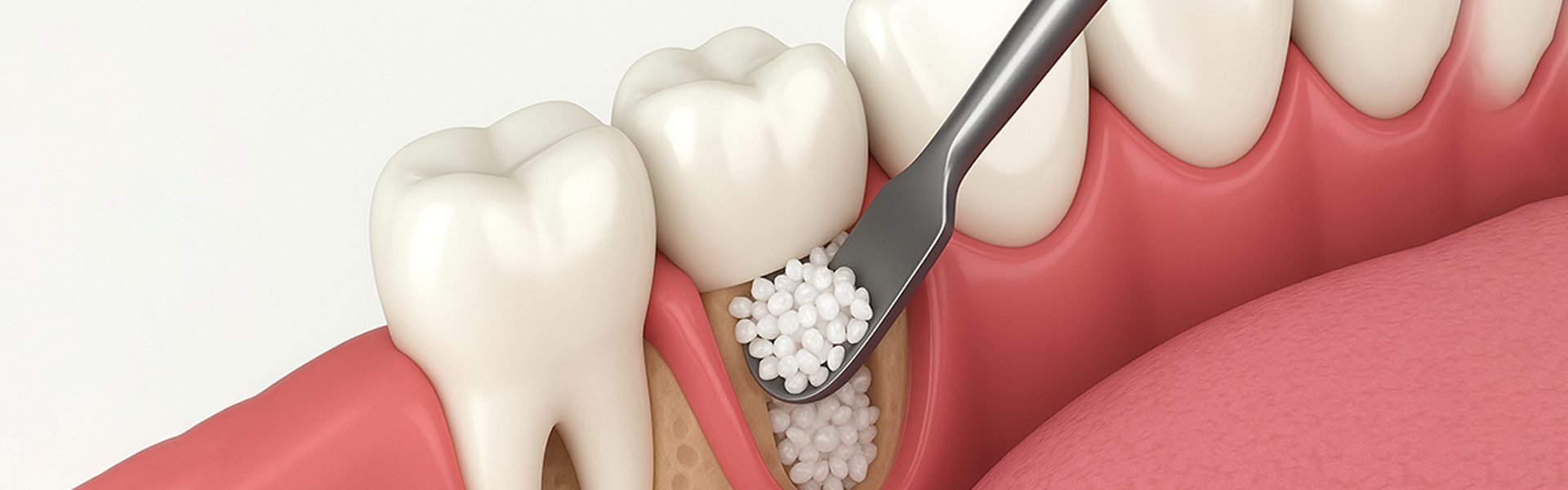Why IV Sedation Makes Bone Grafting Easier for Patients