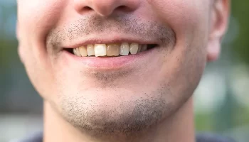 How to Remove Grey Stains on Teeth Near Gum?