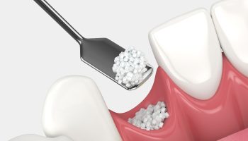 Symptoms of Bone Loss in Teeth and When to See a Dentist