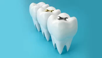 Cracked Filling in a Tooth: Signs You Should See a Dentist